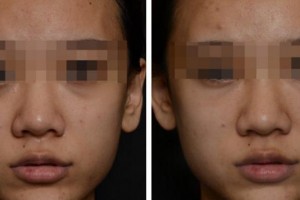 衢州愛爾眼科醫(yī)院李毓敏整形價(jià)格表附膠原蛋白填淚溝案例展示