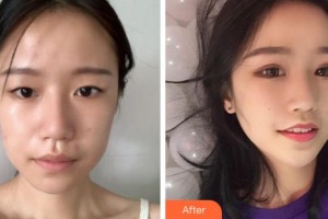 衢州愛爾眼科醫(yī)院周武英整形價(jià)格表附眼部整形案例展示