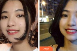 衢州寶爾口腔診所姜寶富整形價(jià)格表附牙齒隱形矯正案例展示