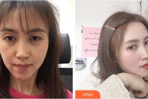 舟山沈虹醫(yī)療美容診所陸彥杰整形價(jià)格表附眼部綜合案例展示