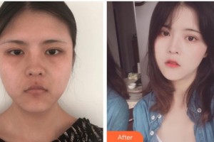 舟山港東醫(yī)療醫(yī)療美容診所季愛琴整形價(jià)格表附埋線提升案例展示