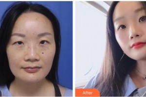 舟山市定海區(qū)中心醫(yī)院眼科王舟盛整形價(jià)格表附祛眼袋案例展示