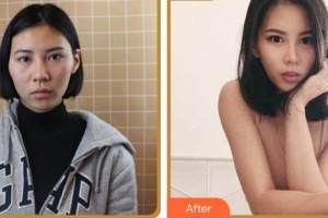 臺(tái)州新鳳凰醫(yī)學(xué)整形美容醫(yī)院陳國(guó)忠整形價(jià)格表附眼部綜合案例展示