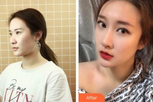 臺(tái)州博仕醫(yī)療整形美容醫(yī)院郭堅(jiān)整形價(jià)格表附鼻部綜合案例展示