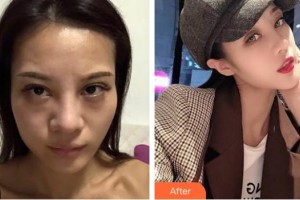 臺(tái)州華美整形美容醫(yī)院何萍整形價(jià)格表附肋軟骨隆鼻案例展示