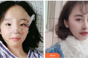 臺(tái)州華美整形美容醫(yī)院劉政整形價(jià)格表附鼻部綜合案例展示