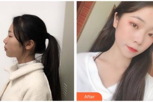 臺(tái)州維多利亞整形美容醫(yī)院蔡意整形價(jià)格表附光子嫩膚案例展示