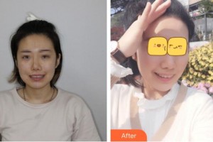 臺(tái)州維多利亞整形美容醫(yī)院藍(lán)?；壅蝺r(jià)格表附牙齒隱形矯正案例展示