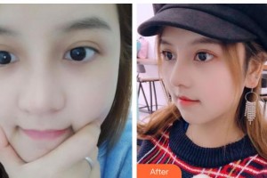 臺(tái)州維多利亞整形美容醫(yī)院上敏明整形價(jià)格表附假體隆鼻案例展示