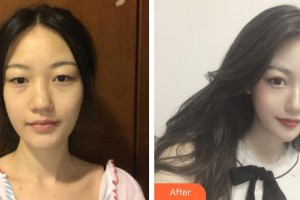 臺(tái)州廣濟(jì)整形美容醫(yī)院逯聯(lián)合整形價(jià)格表附鼻部綜合案例展示