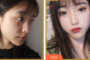 臺(tái)州骨傷醫(yī)院整形美容科蔣冰峰整形價(jià)格表附埋線提升案例展示