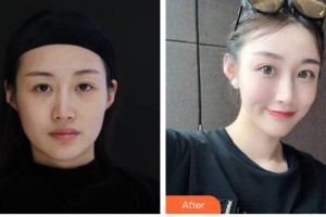 臺(tái)州市立醫(yī)院燒傷整形外科時(shí)述黨整形價(jià)格表附埋線提升案例展示