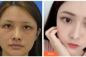 臺(tái)州愛(ài)美美萊醫(yī)療美容門診部金潔整形價(jià)格表附埋線提升案例展示