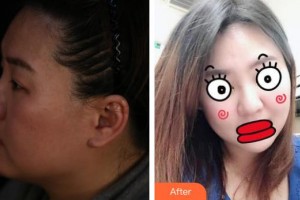 臺(tái)州愛(ài)美美萊醫(yī)療美容門診部劉冠超整形價(jià)格表附埋線提升案例展示