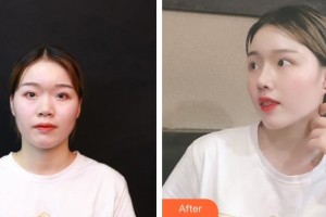 臺(tái)州維多利亞整形美容醫(yī)院金炳湘整形價(jià)格表附肋軟骨隆鼻案例展示