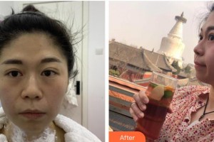 臺(tái)州愛(ài)美美萊醫(yī)療美容門(mén)診部趙德明整形價(jià)格表附熱瑪吉案例展示