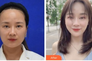 臺(tái)州仁登醫(yī)療美容門(mén)診部陳道明整形價(jià)格表附埋線提升案例展示