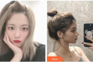 臺(tái)州仁登醫(yī)療美容門(mén)診部林峰整形價(jià)格表附鼻部綜合案例展示