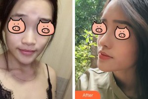 臺(tái)州納恩妮亞醫(yī)療美容醫(yī)院崔妮娜整形價(jià)格表附鼻部綜合案例展示