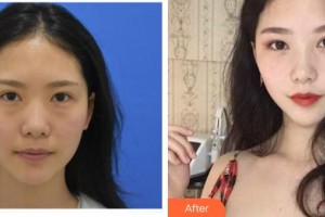 臺(tái)州恩璨醫(yī)療美容門(mén)診部曠健整形價(jià)格表附激光去眼袋案例展示