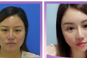 臺(tái)州恩璨醫(yī)療美容門(mén)診部汪堡壘整形價(jià)格表附激光去眼袋案例展示