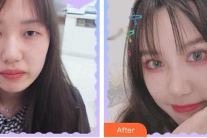 臺(tái)州恩璨醫(yī)療美容門(mén)診部鐘銀祥整形價(jià)格表附眼部綜合案例展示