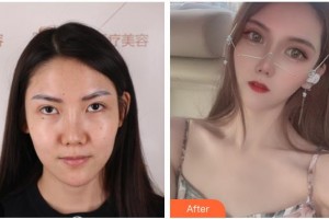 臺(tái)州韓爾口腔門(mén)診部郟海江整形價(jià)格表附切開(kāi)雙眼皮案例展示