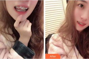 臺(tái)州韓爾口腔門(mén)診部陳學(xué)良整形價(jià)格表附金屬托槽矯正案例展示