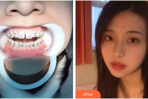 臺(tái)州牙博士口腔門(mén)診部劉丹旭整形價(jià)格表附隱形托槽矯正案例展示