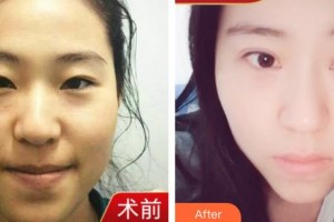 臺(tái)州國(guó)際眼科醫(yī)院姜珺整形價(jià)格表附眼部綜合案例展示