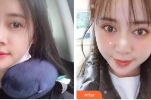 臺(tái)州牙科醫(yī)院林青整形價(jià)格表附自鎖托槽矯正案例展示