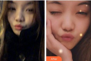 臺(tái)州牙科醫(yī)院王佰軍整形價(jià)格表附牙齒隱形矯正案例展示