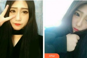 臺(tái)州牙科醫(yī)院邱偉強(qiáng)整形價(jià)格表附牙齒隱形矯正案例展示