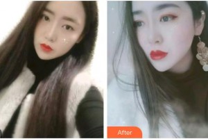 臺(tái)州牙科醫(yī)院顏齊律整形價(jià)格表附金屬托槽矯正案例展示