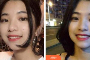 臺州康貝佳口腔醫(yī)院蔡騎兵整形價(jià)格表附牙齒隱形矯正案例展示