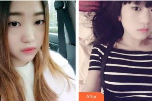 臺州貝雅口腔醫(yī)院王文敏整形價(jià)格表附金屬托槽矯正案例展示