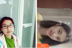 臺州康貝佳口腔醫(yī)院宋文斯整形價(jià)格表附金屬托槽矯正案例展示