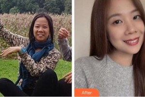 臺州貝雅口腔醫(yī)院羅剛整形價(jià)格表附金屬托槽矯正案例展示