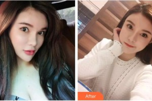 臺州貝雅口腔醫(yī)院史佩強(qiáng)整形價(jià)格表附超聲波潔牙案例展示