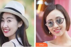 臺州牙博士口腔門診部梁星天整形價(jià)格表附隱形托槽矯正案例展示