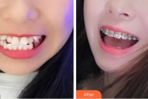 臺州牙博士口腔門診部簡小沖整形價(jià)格表附金屬托槽矯正案例展示