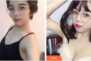 臺州市第一人民醫(yī)院醫(yī)療美容科張勇整形價(jià)格表附自體脂肪隆胸案例展示