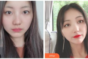 臺州愛爾眼科醫(yī)院解林根整形價(jià)格表附眼部綜合案例展示