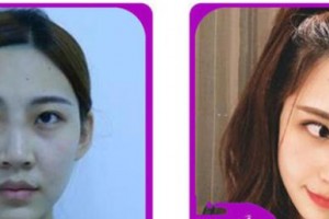 臺州愛爾眼科醫(yī)院張曉整形價(jià)格表附眼部綜合案例展示