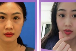 臺州市第一人民醫(yī)院醫(yī)療美容科程茜整形價(jià)格表附激光去眼袋案例展示