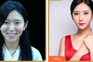 臺州國際眼科醫(yī)院葉正輝整形價(jià)格表附眼部綜合案例展示