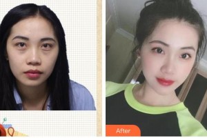 臺州國際眼科醫(yī)院王時(shí)力整形價(jià)格表附激光去眼袋案例展示