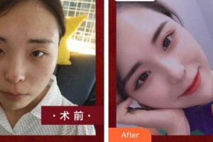 臺州國際眼科醫(yī)院張佳整形價(jià)格表附眼部綜合案例展示