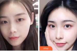 臺州國際眼科醫(yī)院王一博整形價(jià)格表附切開雙眼皮案例展示