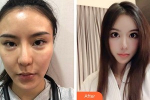 臺州國際眼科醫(yī)院崔樂樂整形價(jià)格表附下瞼整形案例展示